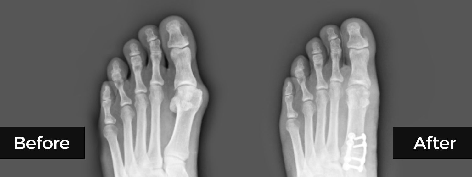Hammertoe - Moore Foot & Ankle